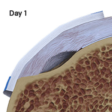 Day 1 Rotator Cuff Tear Treatment