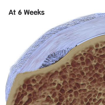 6 Weeks on Rotator Cuff Repair