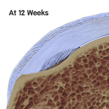 12 Weeks on Regeneten Patchs