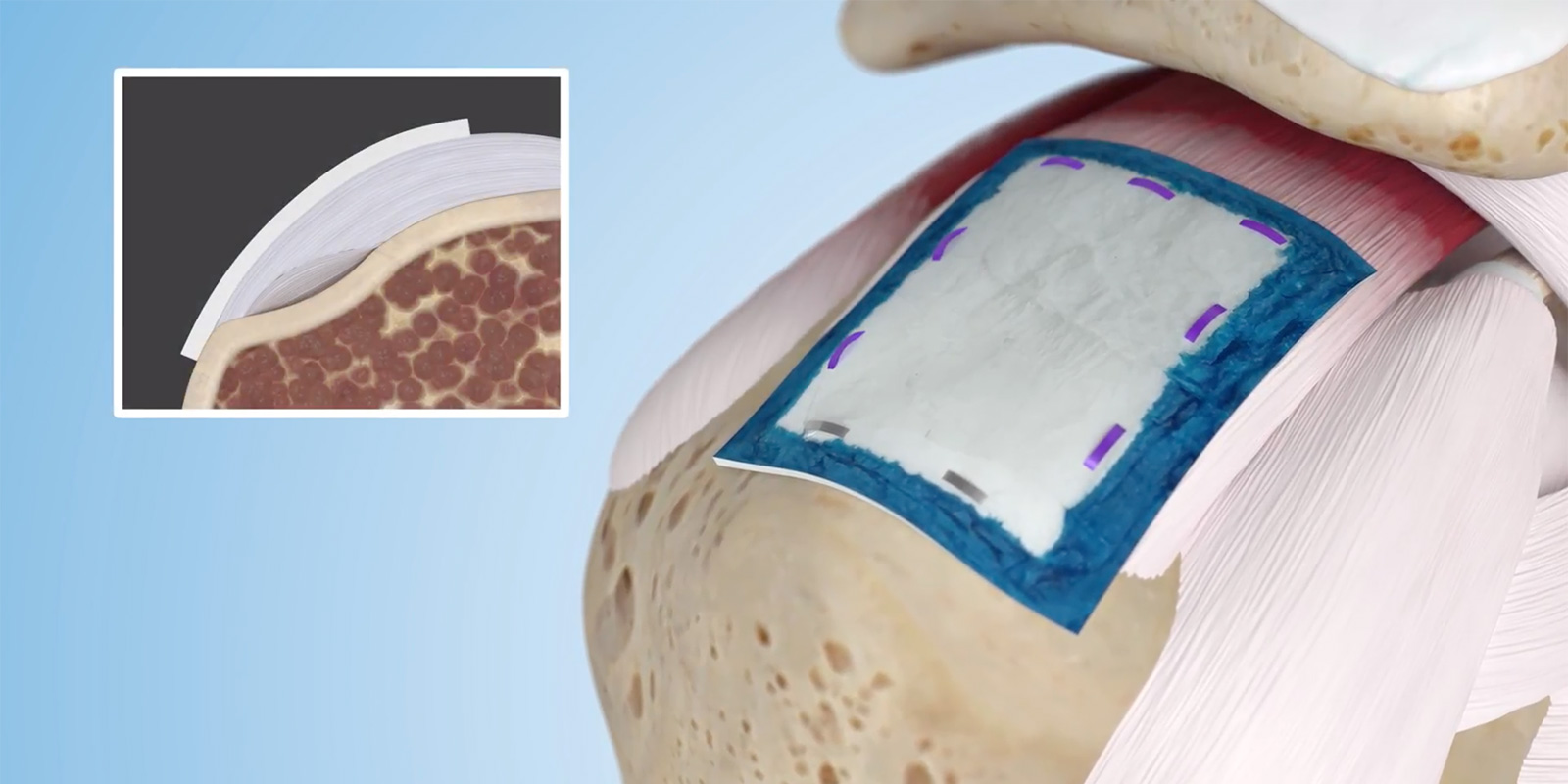 Dr Dorf Rotator Cuff & Shoulder Regeneten Patch Surgery